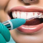 Cómo limpiar las carillas dentales para mantener su brillo y salud