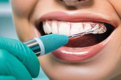 Cómo limpiar las carillas dentales para mantener su brillo y salud